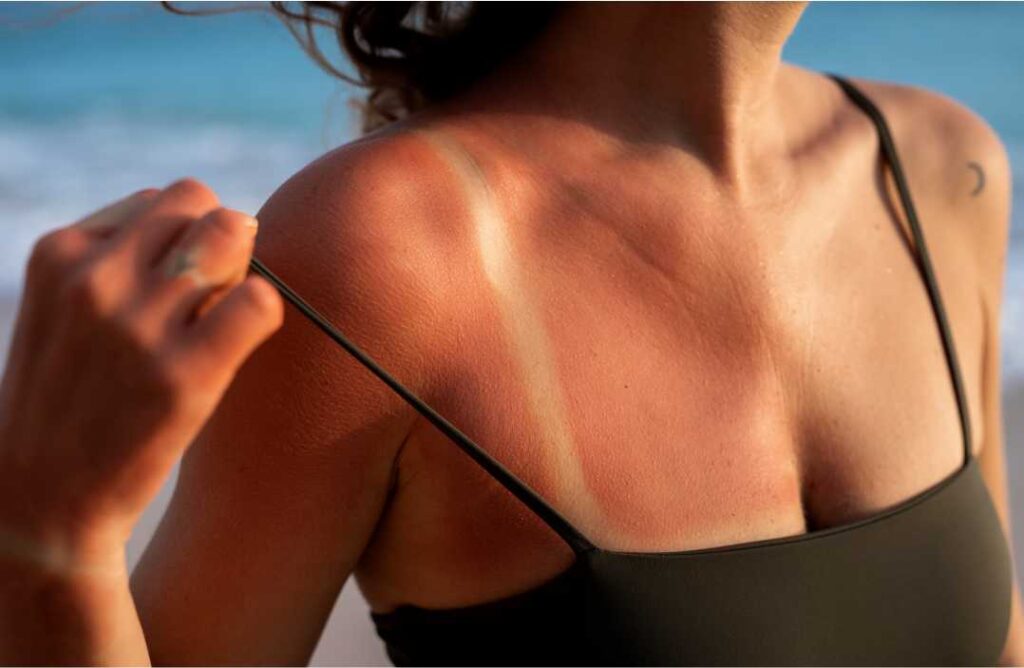 Kako ublaziti opekline od sunca
